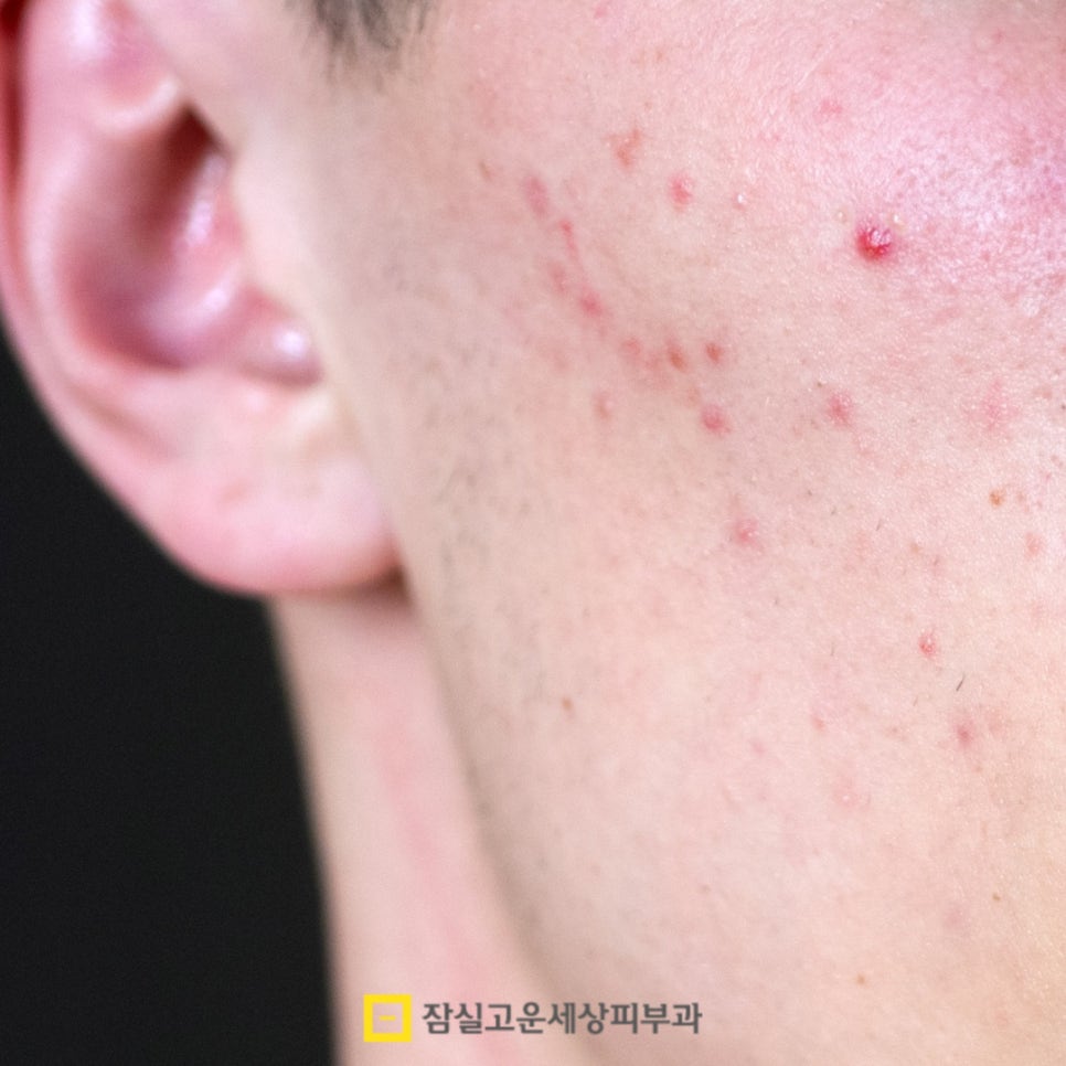 여드름 약, 복용 전 꼭 알아야 할 5가지 핵심 포인트 관련 이미지 2