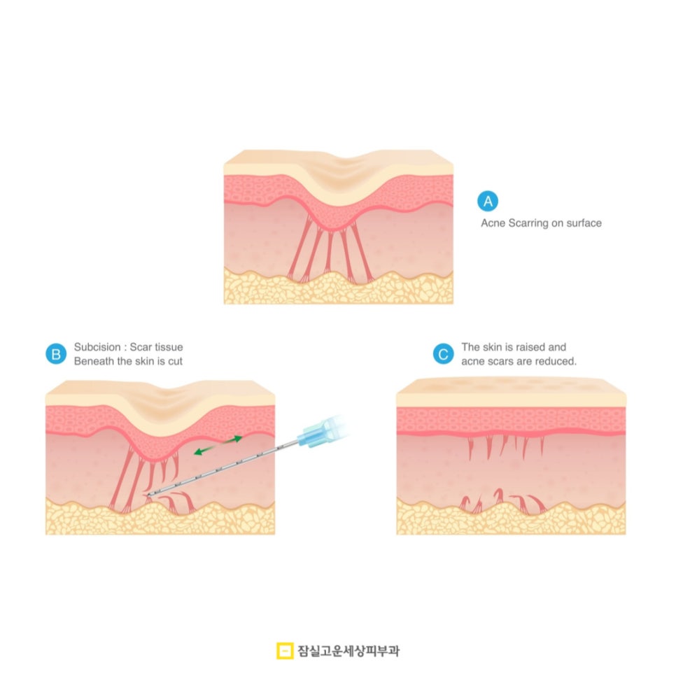[잠실고운세상피부과] 여드름흉터, 골든타임 놓치지 않는 체계적 관리법 관련 이미지 4