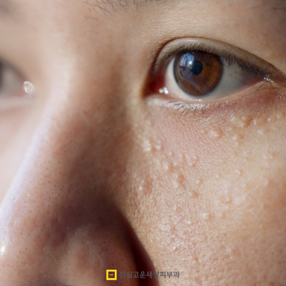 피부에 나타나는 작은 돌기, 편평사마귀에 대해 알아야 할 모든 것 관련 이미지 6