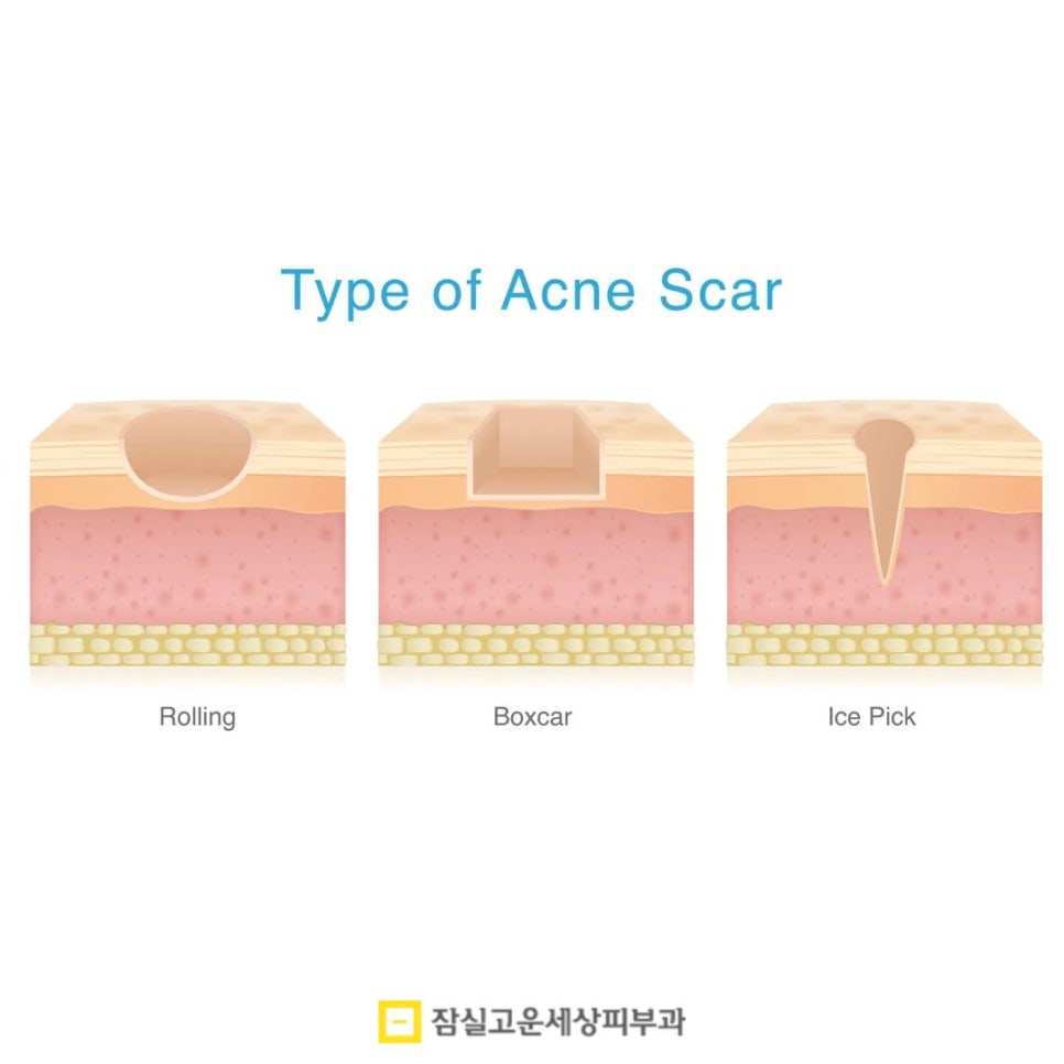 여드름 흉터, 왜 유형에 따라 치료 방법이 달라져야 할까? 관련 이미지 3