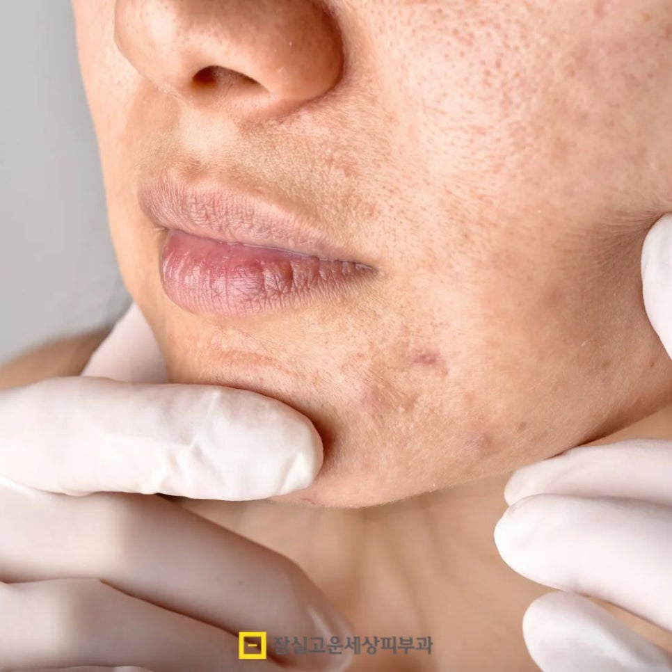 여드름 흉터, 왜 유형에 따라 치료 방법이 달라져야 할까? 관련 이미지 6