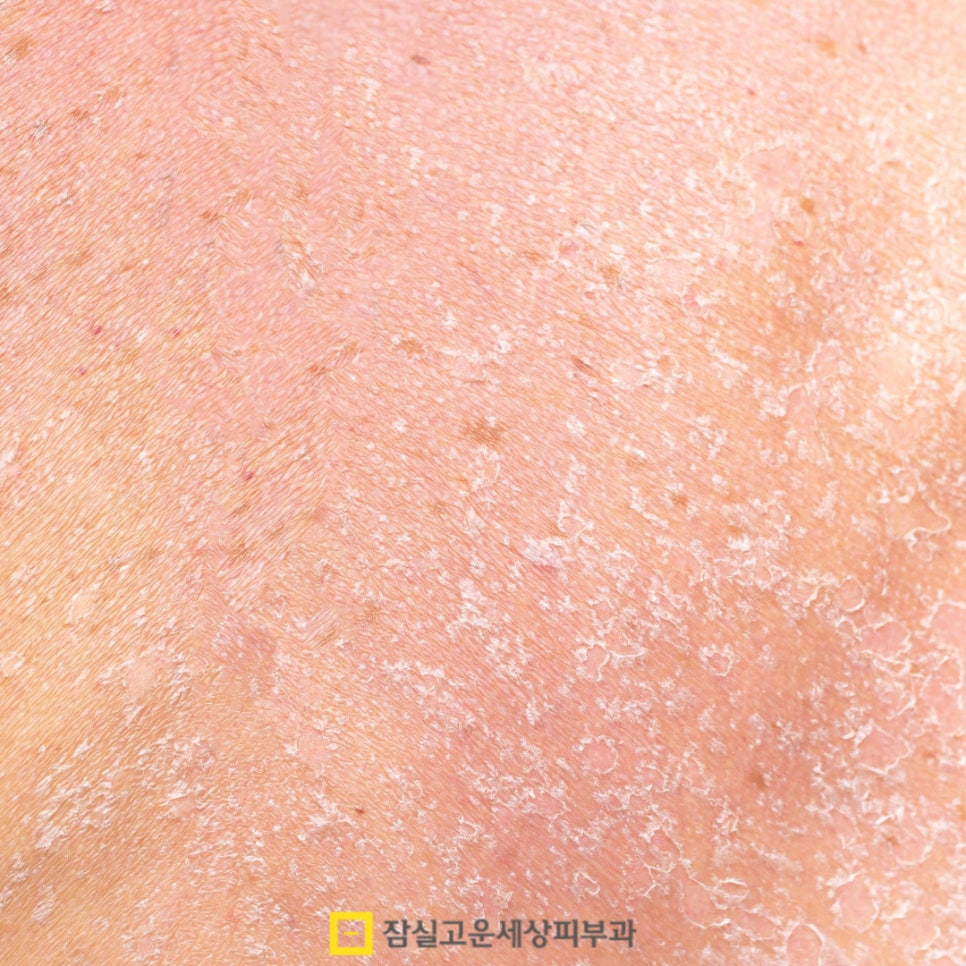 환절기에 더 심해지는 피부 건조, 어떻게 관리해야 할까? 관련 이미지 2