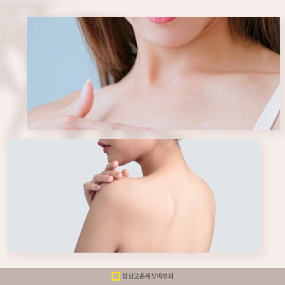 여름철 등드름과 가드름 완전 정복! 시원한 옷차림을 위한 완벽 가이드 관련 이미지 12