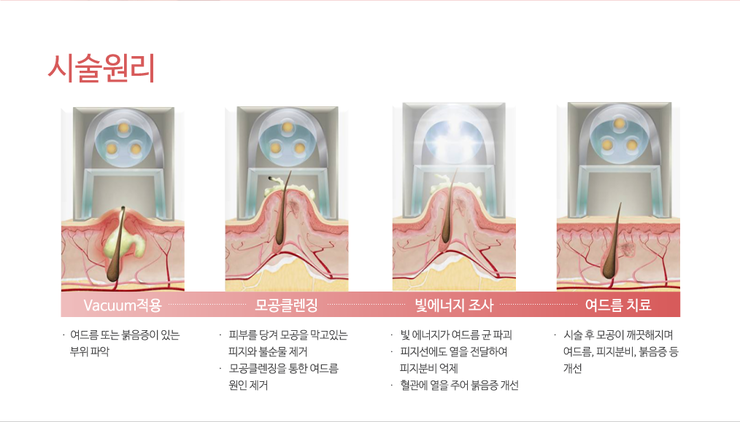 피부과전문의가 알려주는 올바른 여드름치료방법! 관련 이미지 5