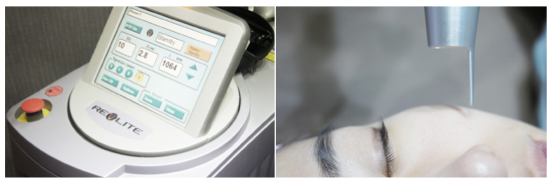 기미제거레이저는 레블라이트! (잠실고운세상피부과/잠실피부과추천) 관련 이미지 4