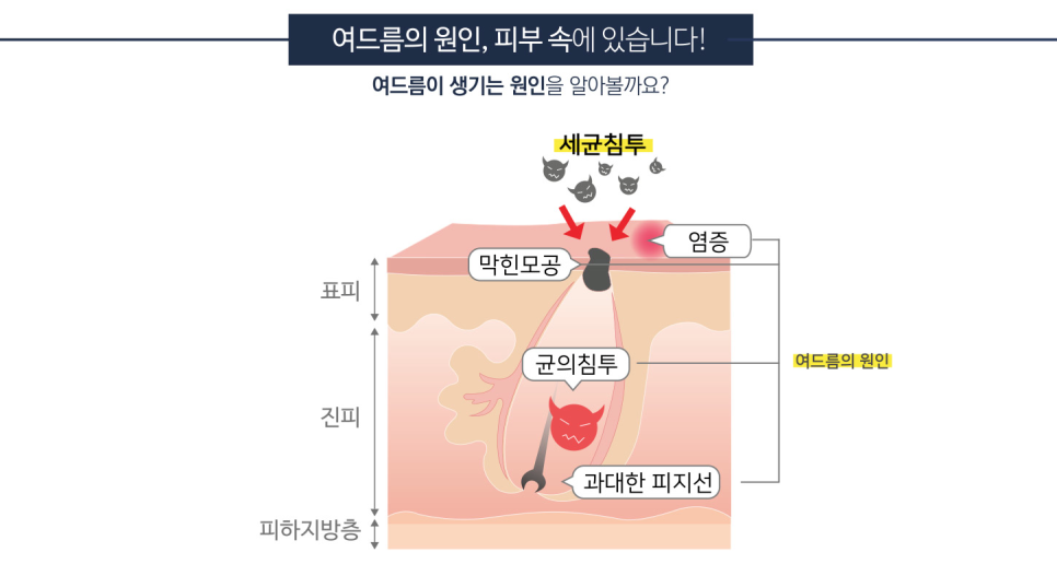 잠실여드름피부과 J핌클케어 여드름치료 관련 이미지 3