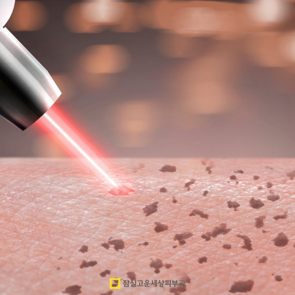 피부에 나타나는 작은 돌기, 편평사마귀에 대해 알아야 할 모든 것 관련 이미지 7