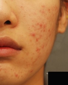 잠실피부관리 메디컬스킨케어로 연휴 후유증 극복! (잠실고운세상피부과/잠실피부과/여드름치료/메디컬스킨케어) 관련 이미지 6