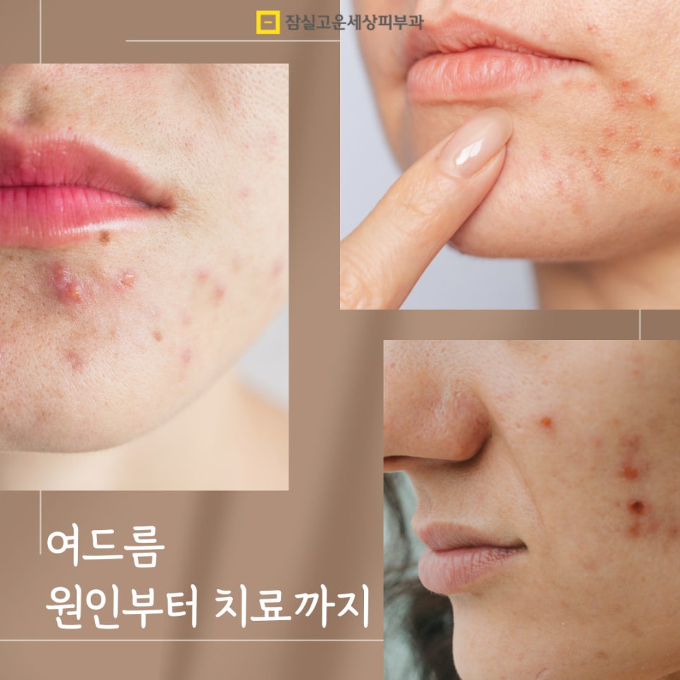 여드름 완전 정복, 원인부터 치료까지 관련 이미지 1