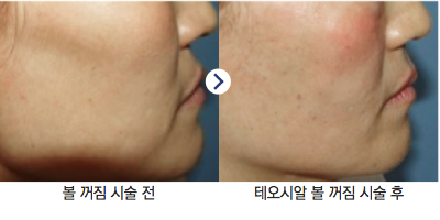 안전한 필러로 안심할 수 있는 곳! 테오시알 필러의 전문성(잠실고운세상피부과/잠실역피부과/명품필러) 관련 이미지 6