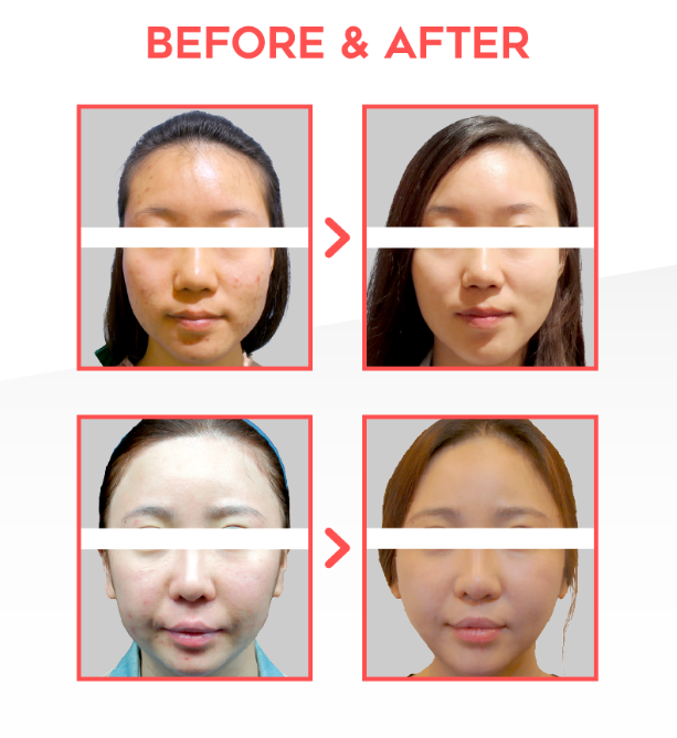 봄꽃축제 시즌, 꽃가루알레르기 피부염 조심하세요! (잠실고운세상피부과) 관련 이미지 12