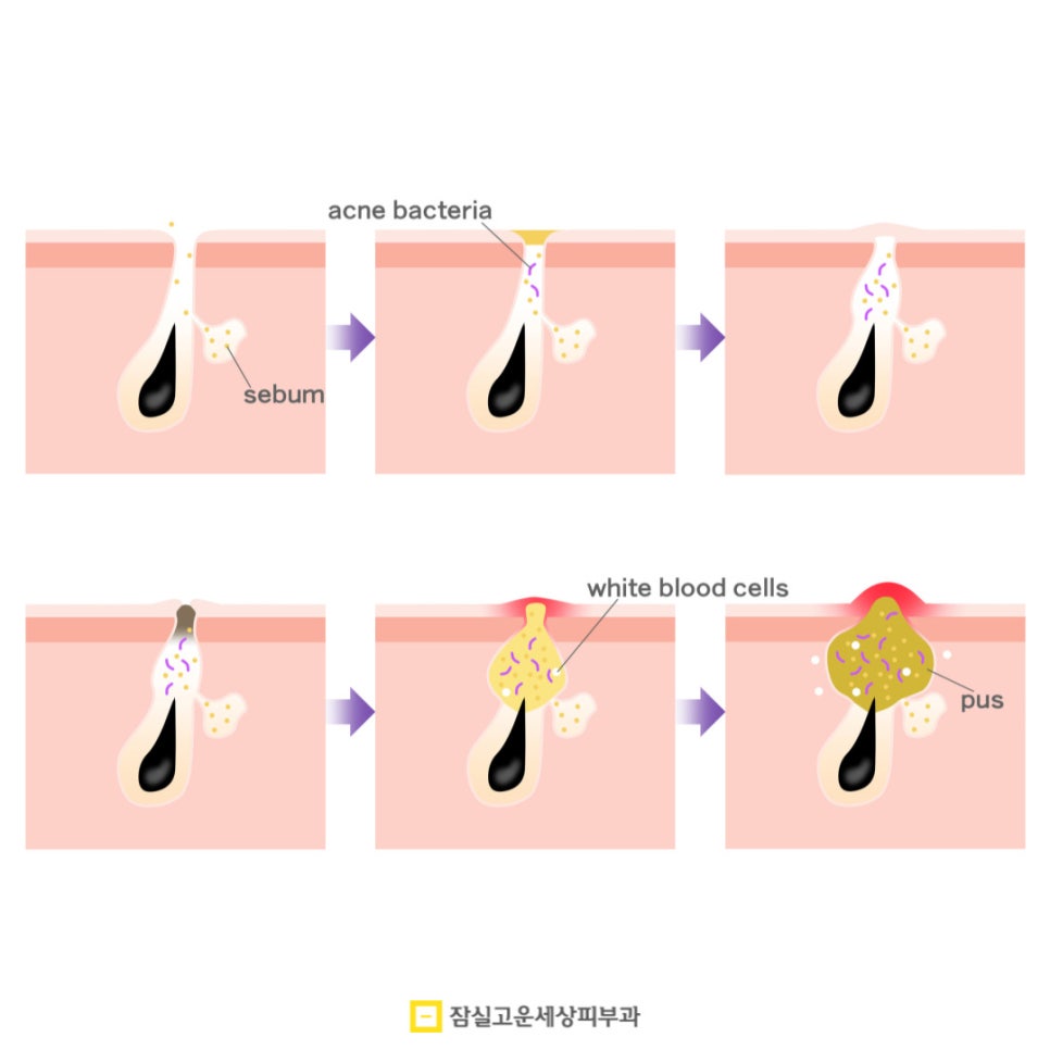 여드름, 반복되는 고민에서 벗어나려면? 관련 이미지 4