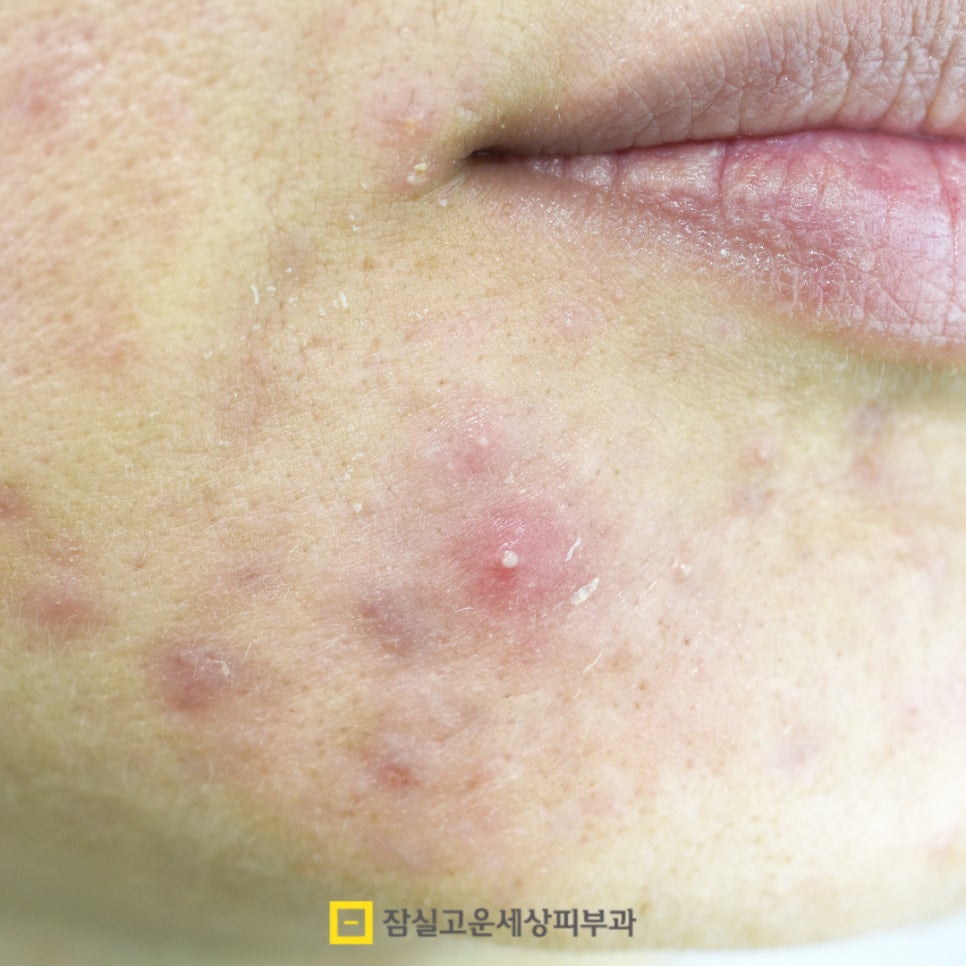 여드름 압출, 왜 해야 하고 어떻게 해야 안전할까? 관련 이미지 3