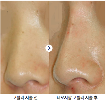 안전한 필러로 안심할 수 있는 곳! 테오시알 필러의 전문성(잠실고운세상피부과/잠실역피부과/명품필러) 관련 이미지 5