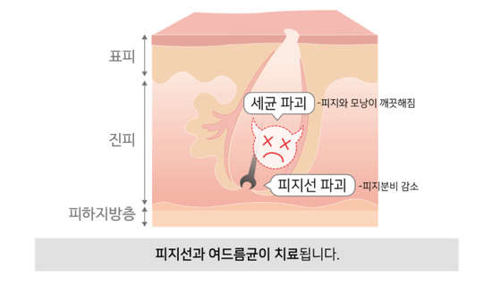잠실여드름피부과 J핌클케어입니다 (잠실고운세상피부과/잠실역피부과) 관련 이미지 7