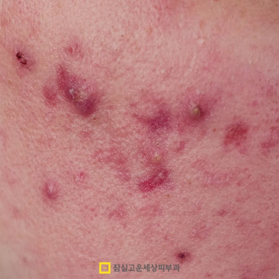 여드름 흉터, 왜 유형에 따라 치료 방법이 달라져야 할까? 관련 이미지 4