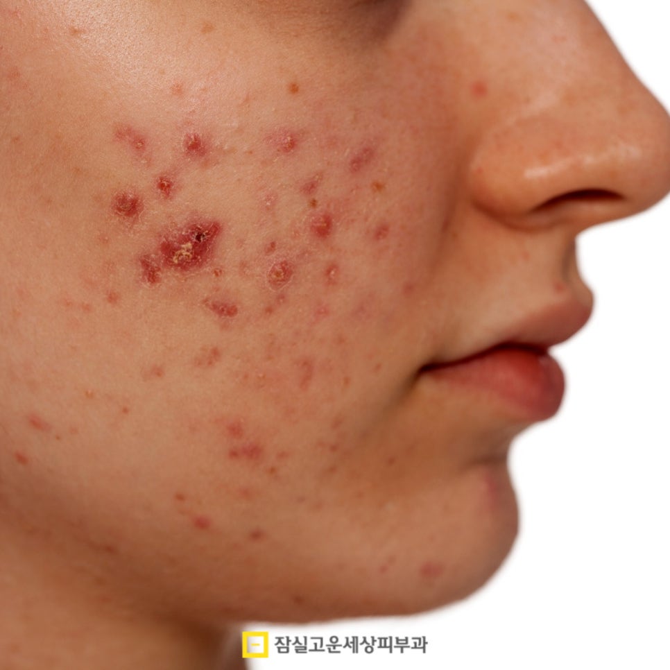 붉고 고름 찬 화농성 여드름의 원인부터 치료까지 관련 이미지 6