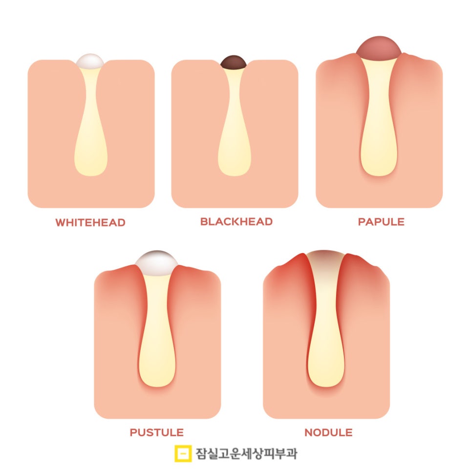 여드름, 왜 치료해도 다시 올라올가? 그리고 재발을 줄이는 방법 관련 이미지 6