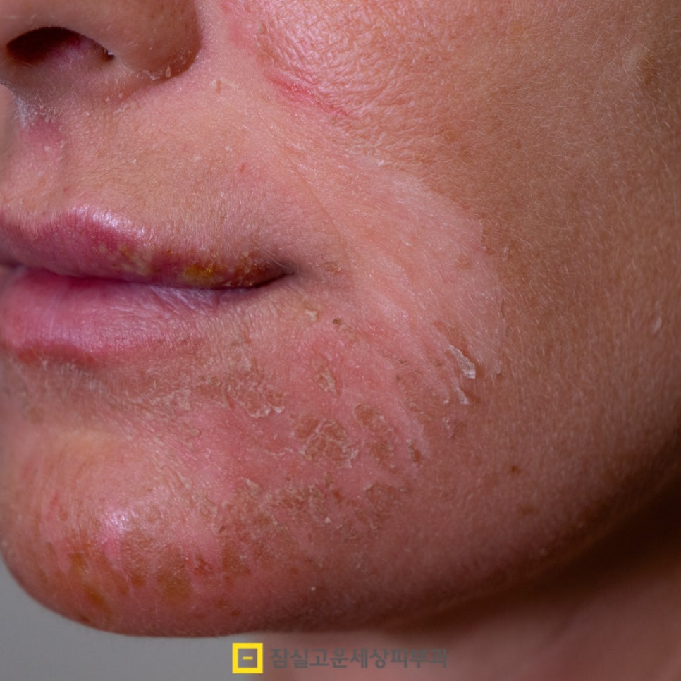 피부 건조, 원인부터 관리까지 알아보기 관련 이미지 7