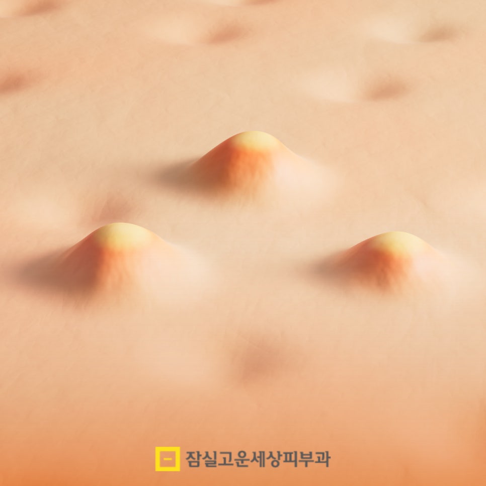 좁쌀 여드름, 왜 자꾸 올라올까요? 관련 이미지 2