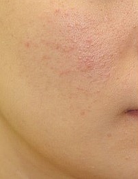 잠실피부관리 메디컬스킨케어로 연휴 후유증 극복! (잠실고운세상피부과/잠실피부과/여드름치료/메디컬스킨케어) 관련 이미지 3