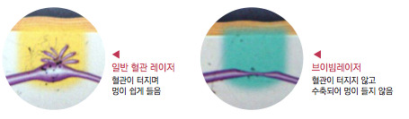 잠실여드름치료 여드름붉은자국도 없앨 수 있나요? (잠실역피부과/여드름흉터제거/여드름자국레이저/브이빔레이저) 관련 이미지 4