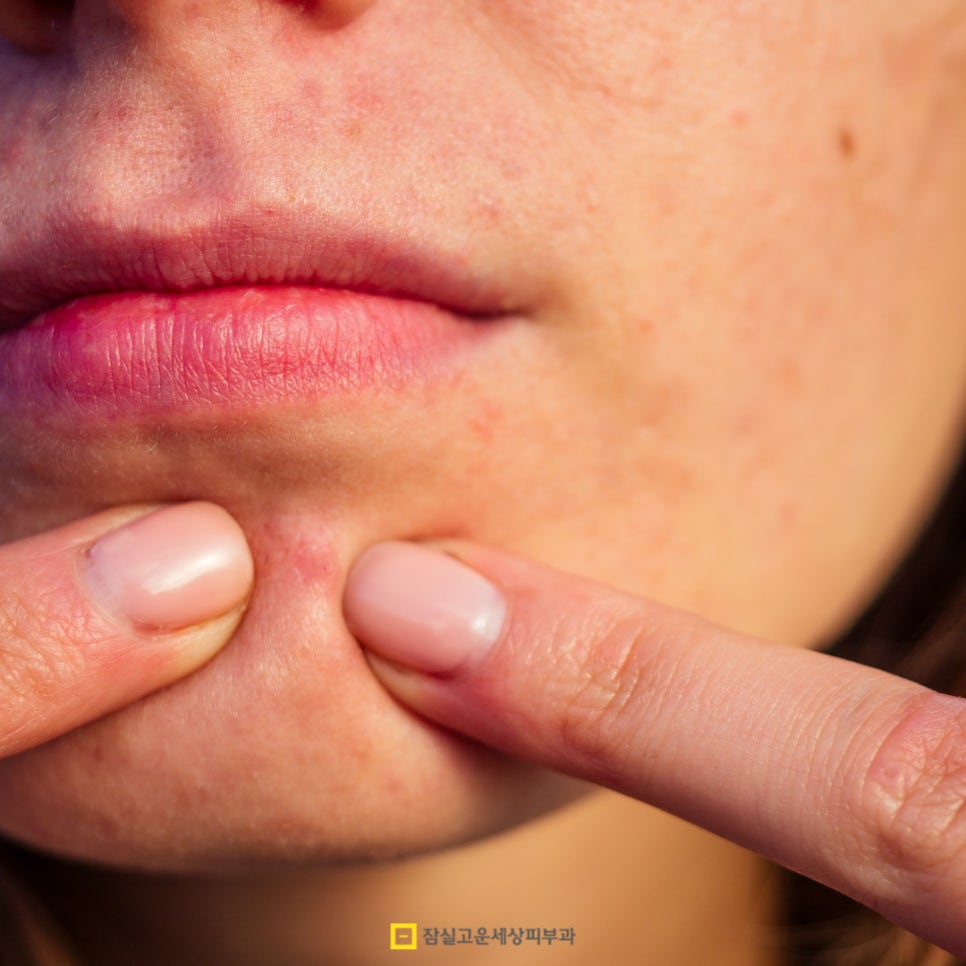 성인 여드름, 사춘기 때 끝난 줄 알았는데 다시 시작된 이유 관련 이미지 6