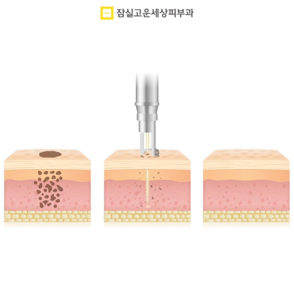 기미 치료의 올바른 접근 방법 관련 이미지 6