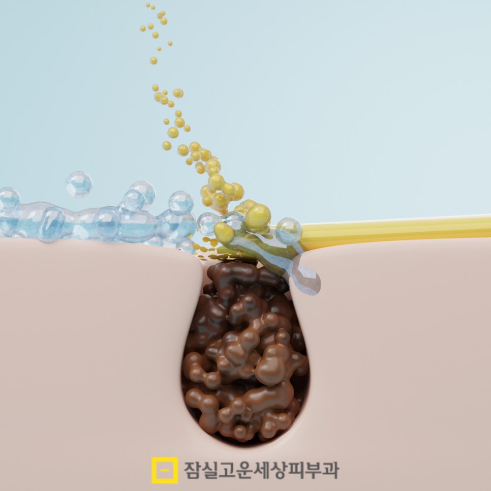 이마 여드름, 왜 자꾸 생길까? 관련 이미지 3