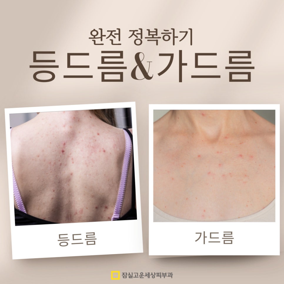 여름철 등드름과 가드름 완전 정복! 시원한 옷차림을 위한 완벽 가이드 관련 이미지 1