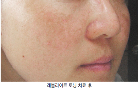 피부나이측정 집에서 하기! 2016 새해 피부나이 이제 그만 먹자! 관련 이미지 5