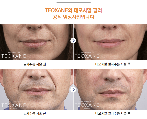 안전한 필러로 안심할 수 있는 곳! 테오시알 필러의 전문성(잠실고운세상피부과/잠실역피부과/명품필러) 관련 이미지 4