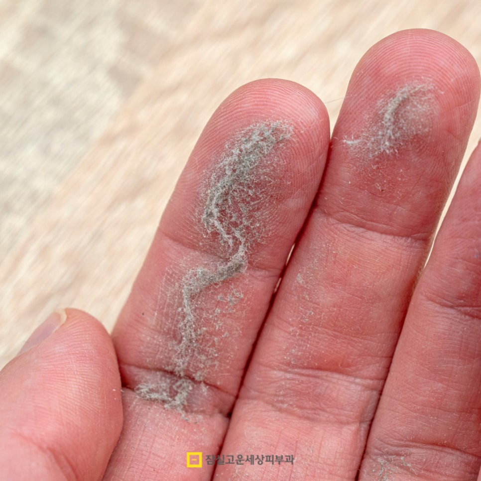 아토피 피부염 완전 가이드 관련 이미지 4