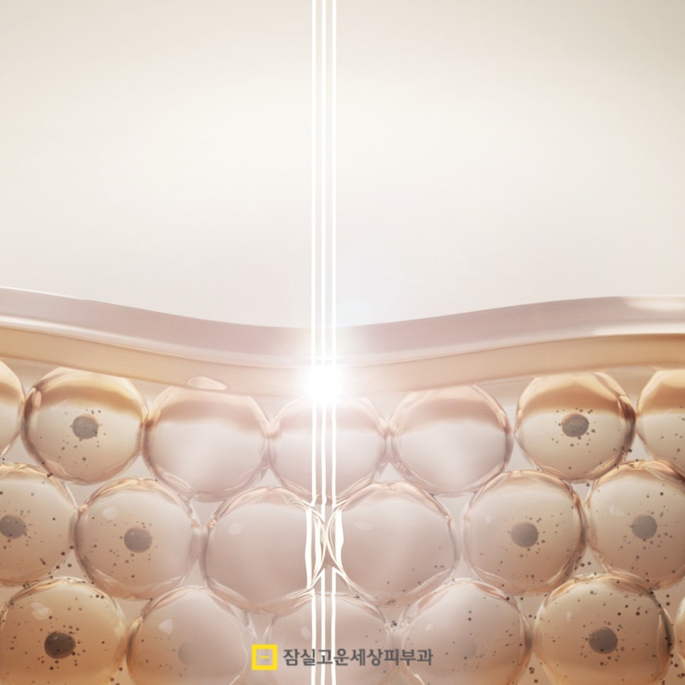 고주파 리프팅, 언제 받는게 가장 효과적일까? 관련 이미지 2