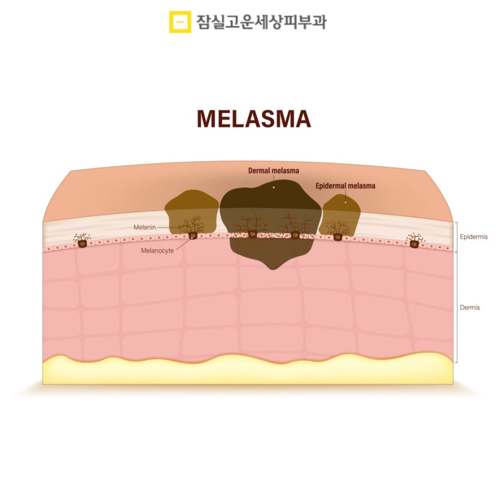 기미 치료의 올바른 접근 방법 관련 이미지 2