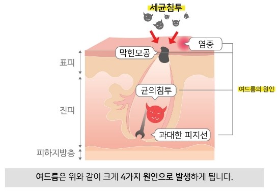 기말고사 스트레스로 인한 여드름, 제대로 잡으려면? 잠실여드름피부과 핌클케어와 함께 하세요!  (잠실여드름/잠실피부과/송파구피부과/여드름치료/여드름케어) 관련 이미지 5