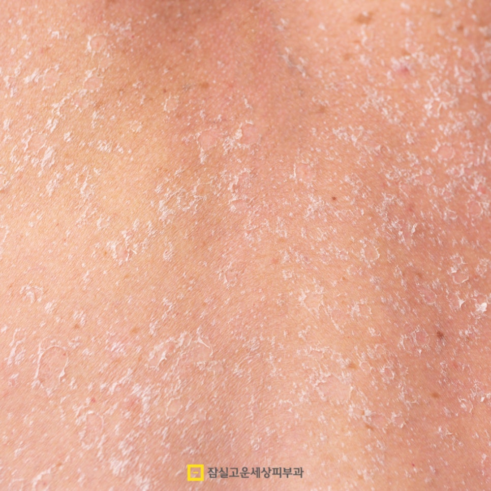 환절기 예민하고 건조한 피부에 효과적인 시술 관련 이미지 2