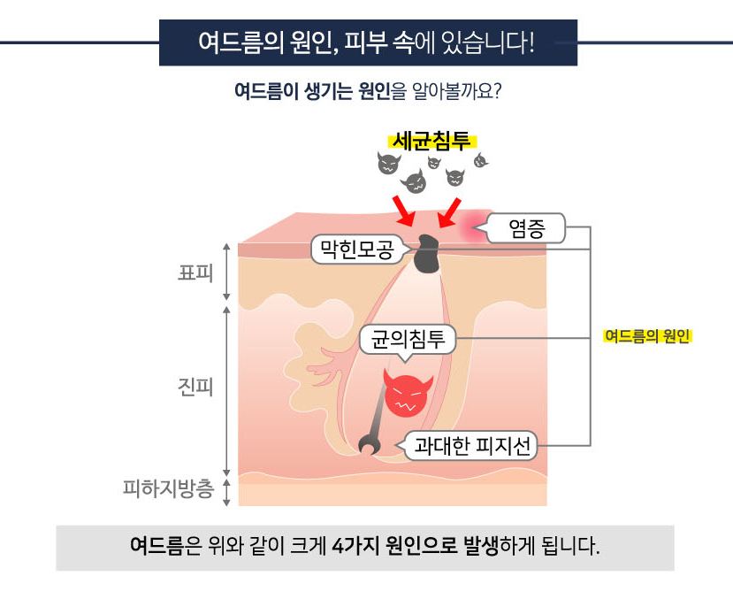 [잠실역피부과] 잠실고운세상피부과, 자꾸 재발하는 여드름 치료방법은? 관련 이미지 3