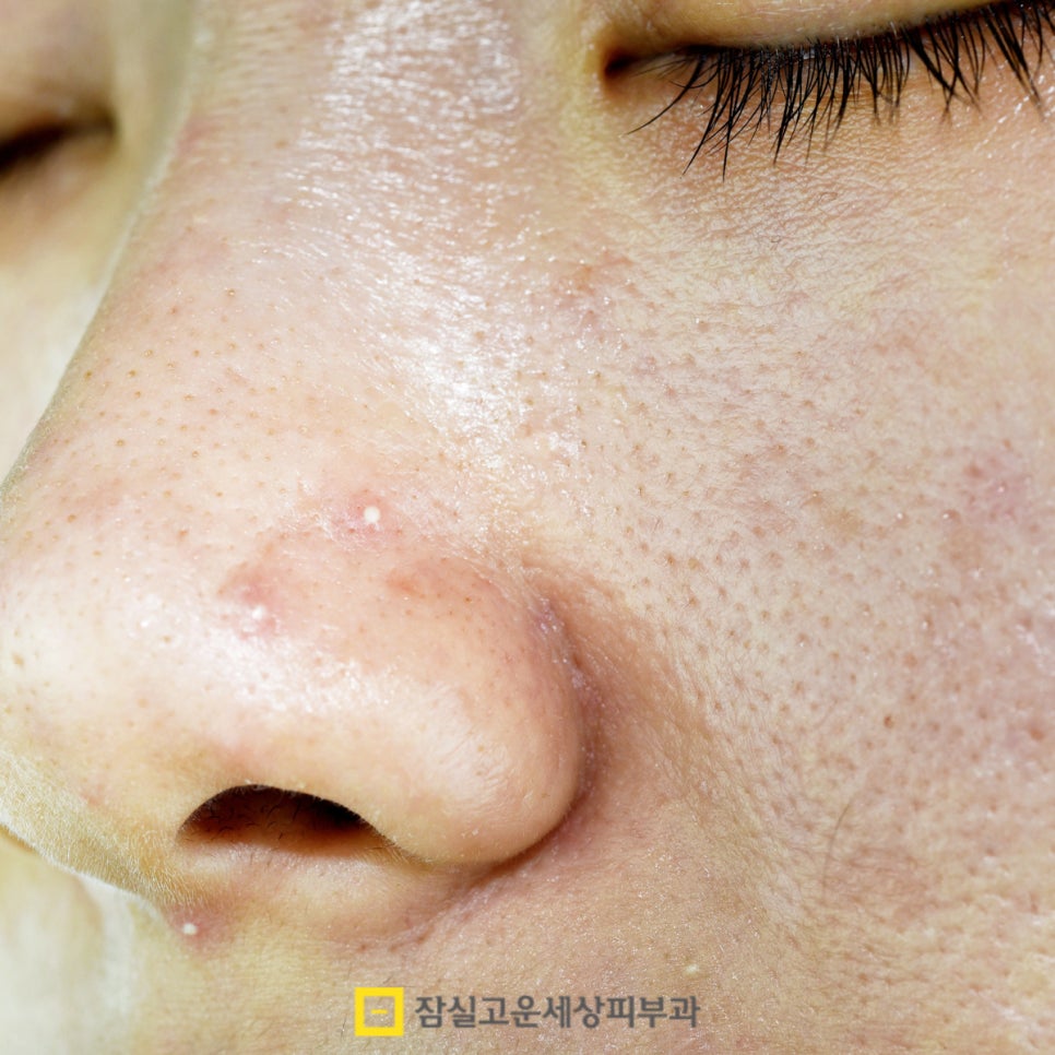 왜 환절기엔 여드름이 더 심해질까요? 관련 이미지 4