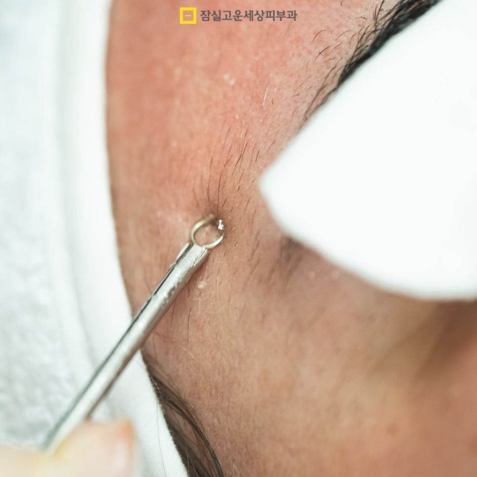 좁쌀여드름 완전 해결, 원인부터 관리까지 관련 이미지 4