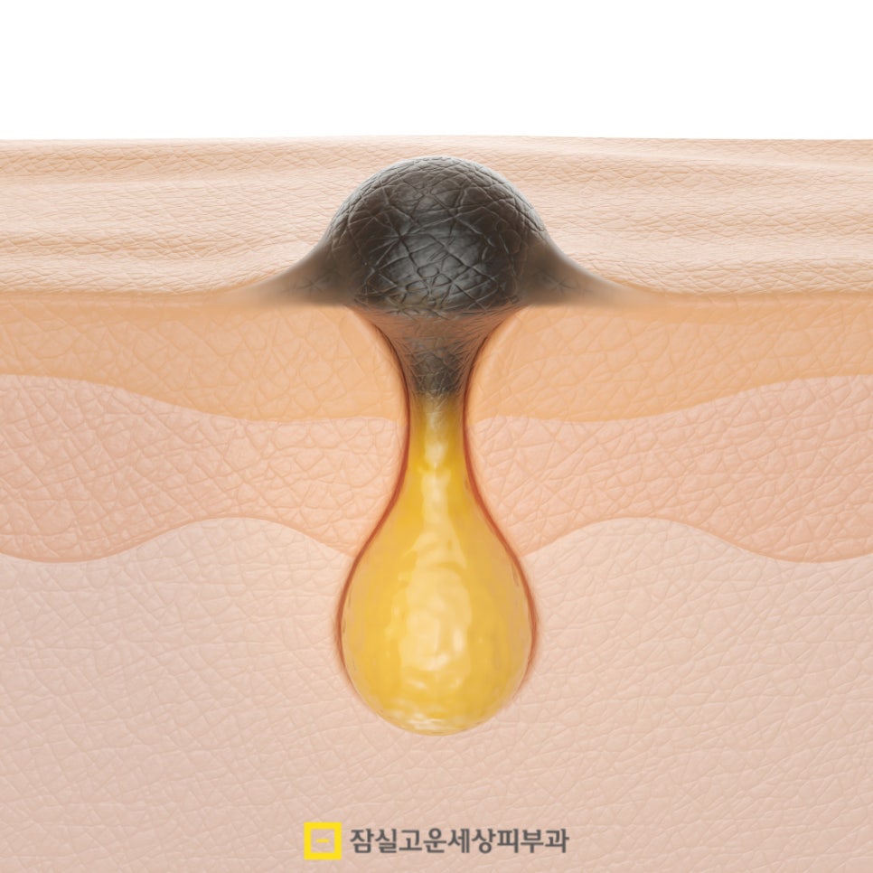 여드름, 단순한 뾰루지가 아닌 피부 질환 관련 이미지 5