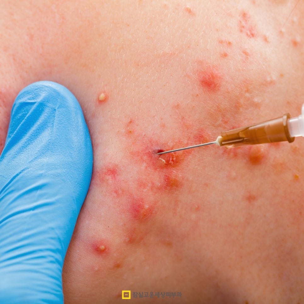 여드름, 일상부터 전문가 케어까지! 관련 이미지 6