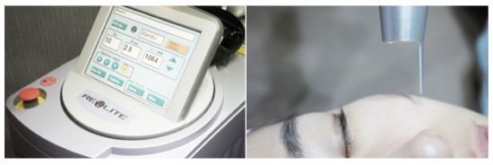 맑고 고운 유리알피부는 레블라이트로! (기미잡티제거/잠실피부과/잠실고운세상피부과) 관련 이미지 5