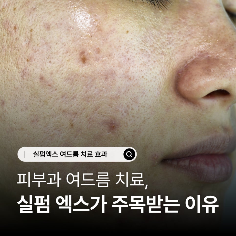 피부과 여드름 치료, 실펌 엑스가 주목받는 이유 관련 이미지 1