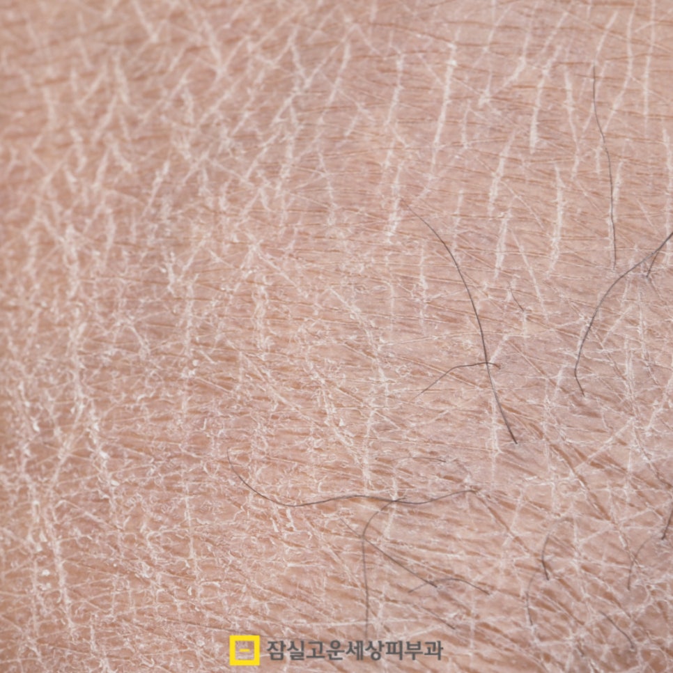 피부 건조, 원인부터 관리까지 알아보기 관련 이미지 9