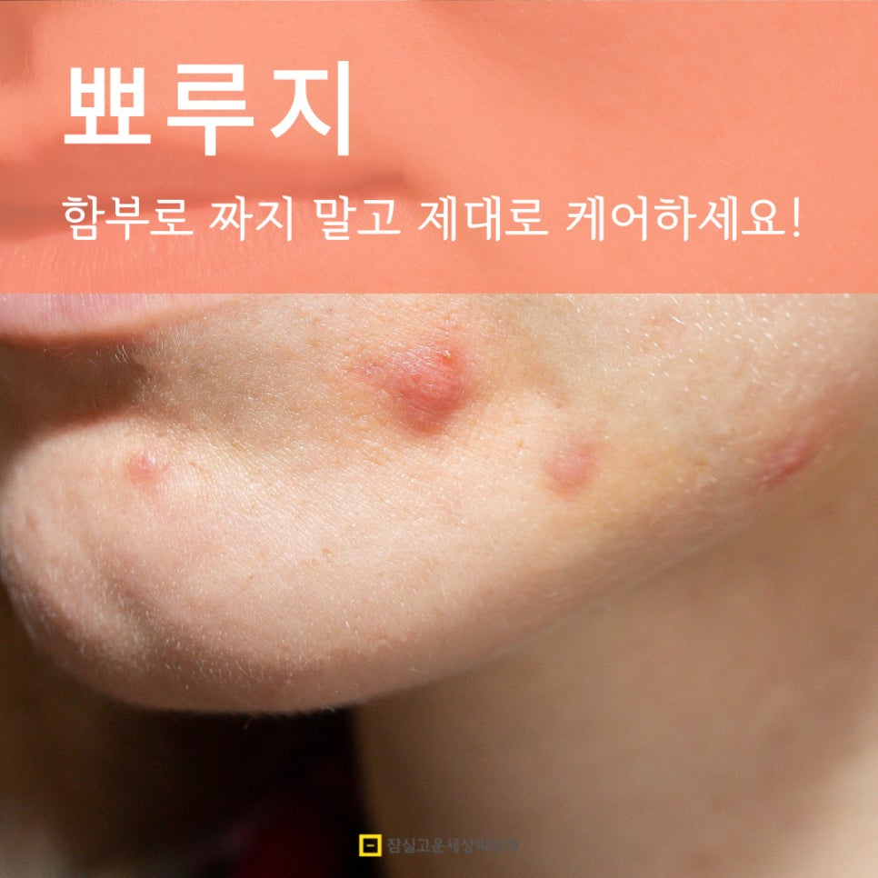 뾰루지 A to Z, 함부로 짜지 말고 제대로 구별하고 케어하세요! 관련 이미지 1