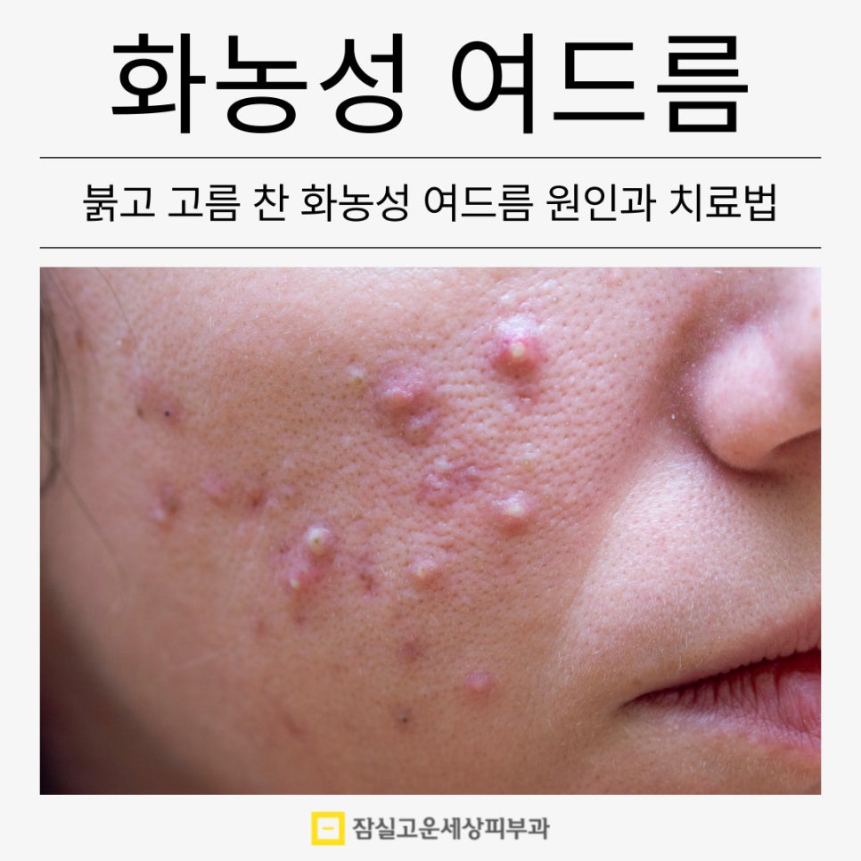 붉고 고름 찬 화농성 여드름의 원인부터 치료까지 관련 이미지 1