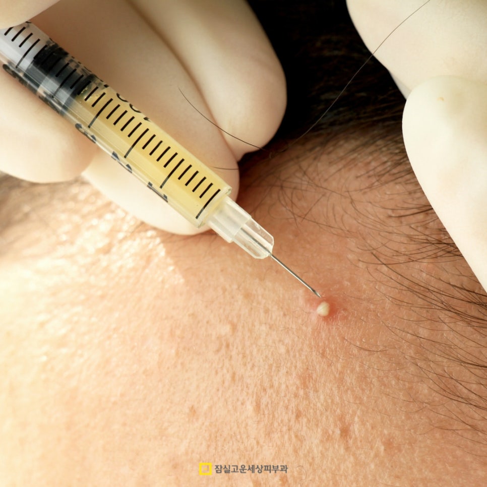 뾰루지 A to Z, 함부로 짜지 말고 제대로 구별하고 케어하세요! 관련 이미지 5