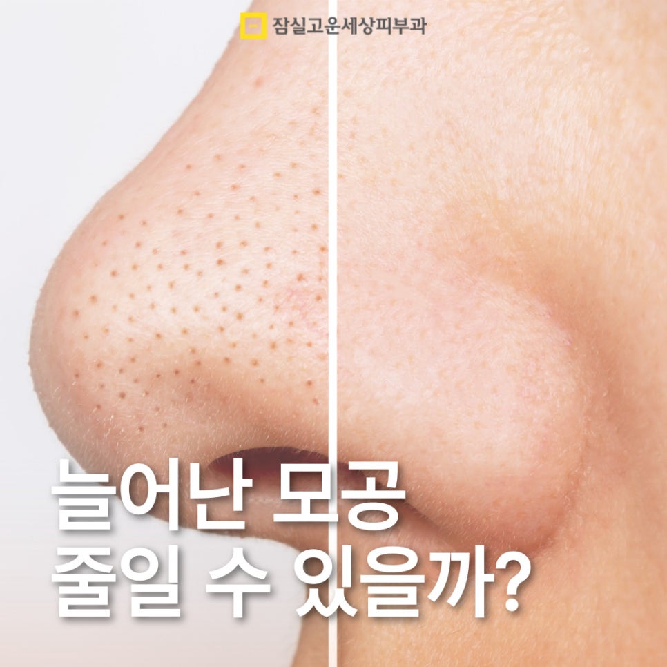 늘어난 모공, 정말 줄일 수 있을까? 관련 이미지 1