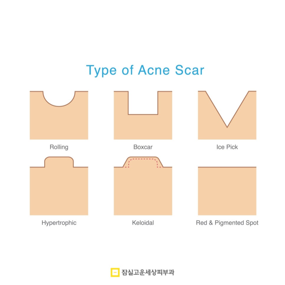 여드름 흉터, 시간이 지나도 사라지지 않는 이유 관련 이미지 5